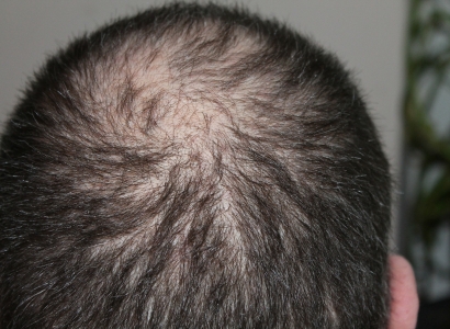 Alopecia: cos'è, cause e cure